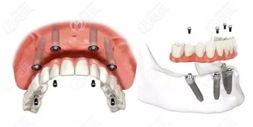 大連牙元素劉洋醫(yī)生種植牙優(yōu)勢(shì) 大連牙元素劉洋醫(yī)生種植牙優(yōu)勢(shì)