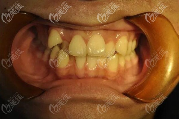 牙齒矯正前 牙齒矯正前