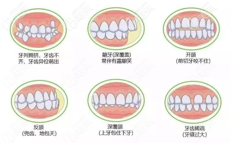 牙齒不齊的危害 牙齒不齊的危害