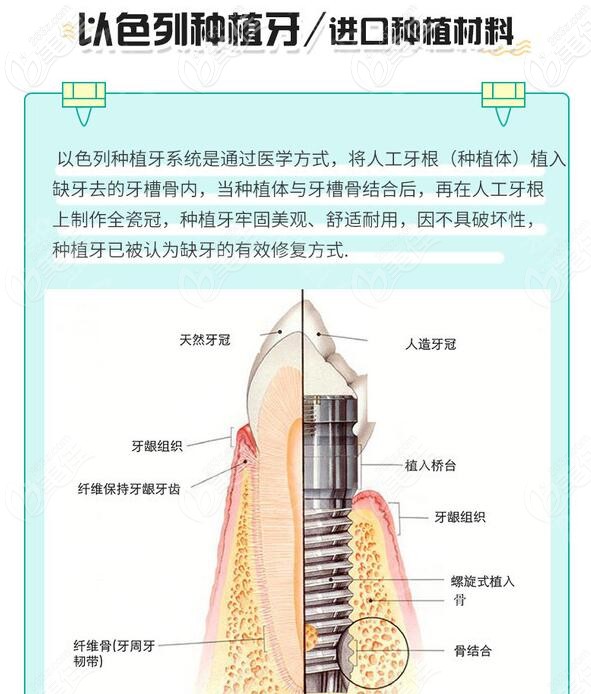 以色列種植牙怎么樣