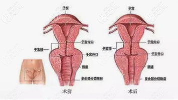 韓國Qline女性醫(yī)院金哉勛陰道緊縮手術(shù)效果圖