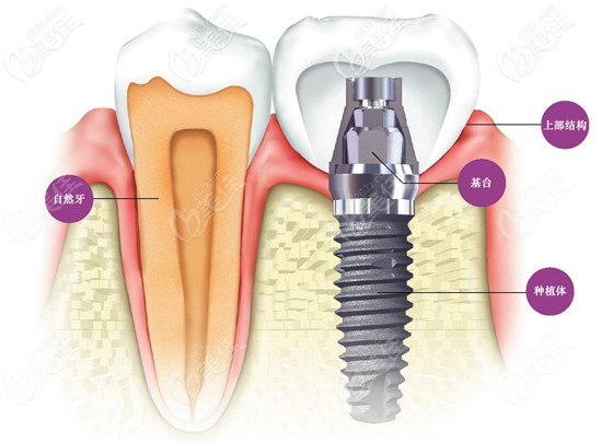 以色列和瑞士種植體哪個好