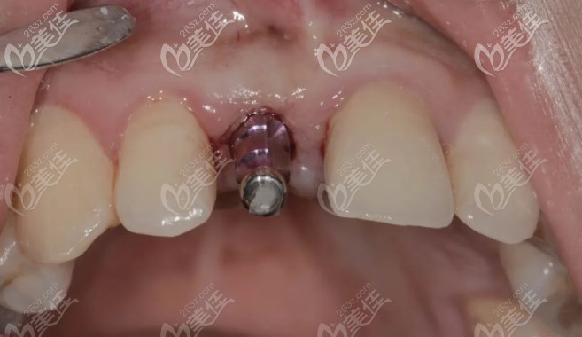 洛陽濟(jì)仁口腔前牙美學(xué)種植 洛陽濟(jì)仁口腔前牙美學(xué)種植