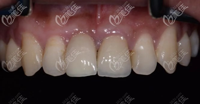 看洛陽濟仁口腔的前牙缺失種植案例,在這家種牙效果好還不貴哦