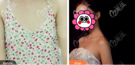 <!--<i data=20240703-sp></i>-->假體隆胸對(duì)比效果圖