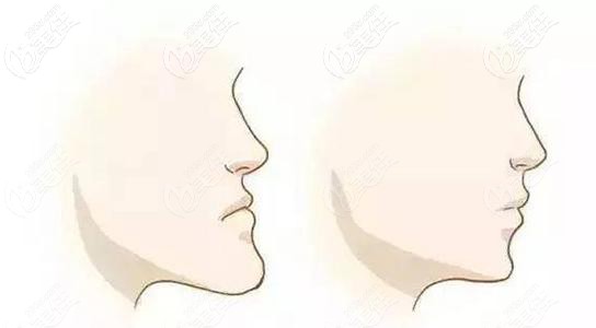 朱彩寅醫(yī)生淺談牙齒矯正能改變臉型嗎