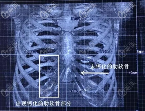 肋軟骨鈣化和正常肋軟骨的區(qū)別 肋軟骨鈣化和正常肋軟骨的區(qū)別