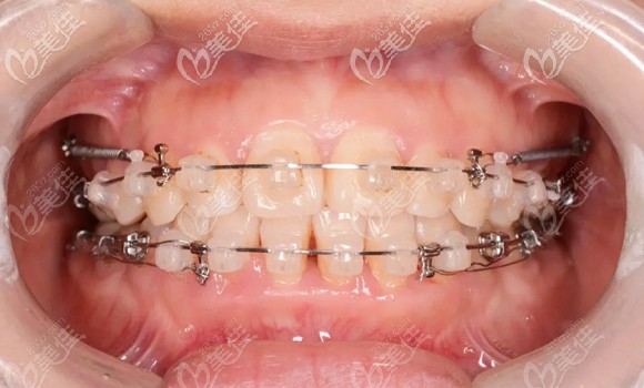 小姐姐在靖江艾齒嘉口腔做了陶瓷半隱形牙套矯正后的走心分享...