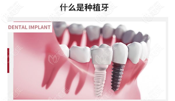 什么是種植牙