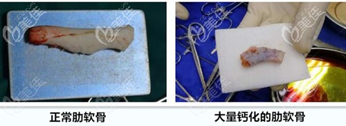 正常肋軟骨和鈣化的肋軟骨 正常肋軟骨和鈣化的肋軟骨