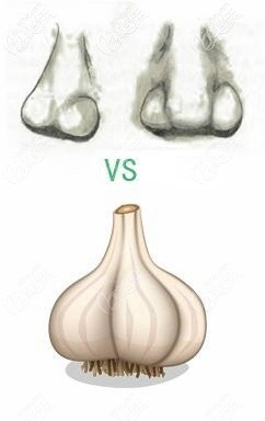 蒜頭鼻鼻型 蒜頭鼻鼻型