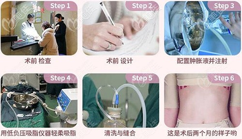 水動力腰腹吸脂過程 水動力腰腹吸脂過程