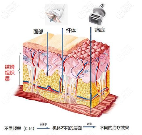 法國(guó)LPG原理
