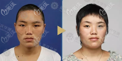 重慶祛疤醫(yī)生彭代智案例 重慶祛疤醫(yī)生彭代智案例