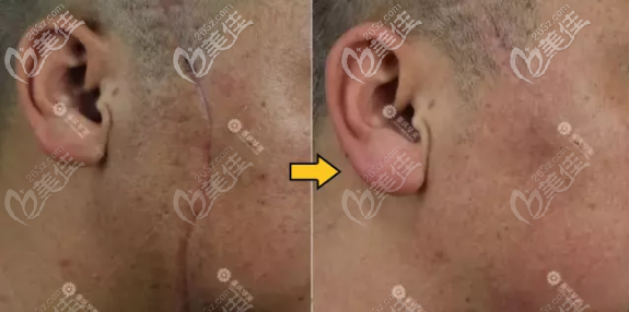 重慶華美祛疤怎么樣 重慶華美祛疤怎么樣