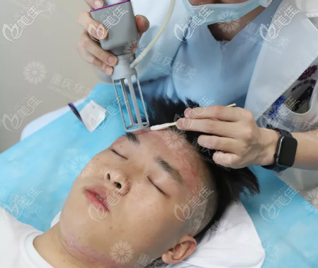 光電儀器治療疤痕圖示 光電儀器治療疤痕圖示