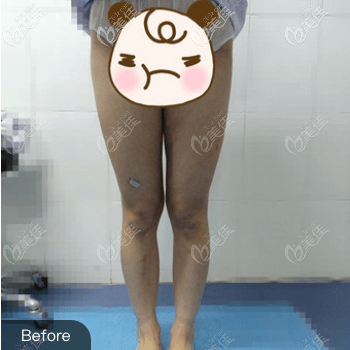 在北京蒂凡妮醫(yī)療美容做大腿吸脂前 在北京蒂凡妮醫(yī)療美容做大腿吸脂前