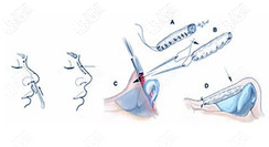 靳玉彪醫(yī)生做鼻子手術示意圖 靳玉彪醫(yī)生做鼻子手術示意圖