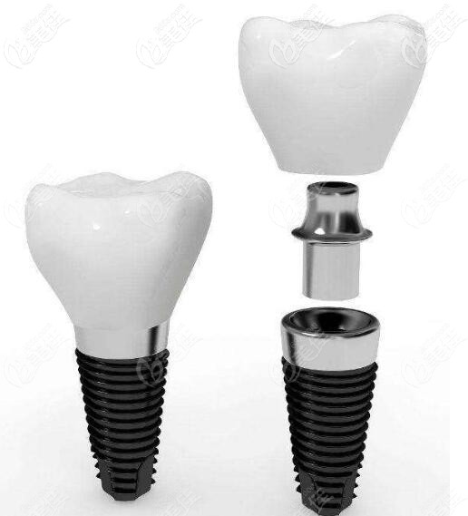 美國(guó)皓圣種植體外形示意圖	