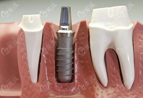 種植牙過(guò)程 種植牙過(guò)程