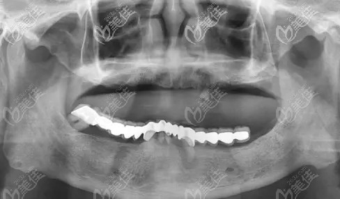 牙齒三度松動(dòng)