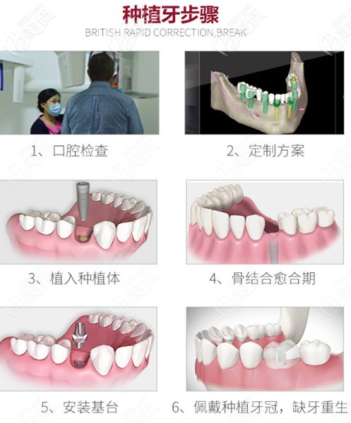 種植牙步驟 種植牙步驟