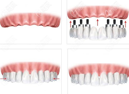 韓國登騰allon4全口種植牙