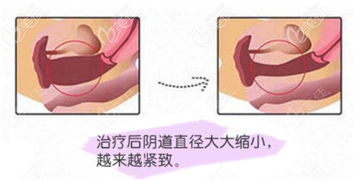 菲蜜麗緊縮術(shù)后效果對比 菲蜜麗緊縮術(shù)后效果對比