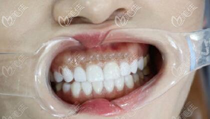 做美國(guó)皓圣種植體三個(gè)月效果圖片