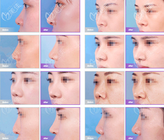 韓國麗顏麗李韓爾鼻綜合案例