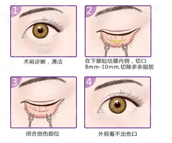 陳振雨做眼部整形的流程 陳振雨做眼部整形的流程