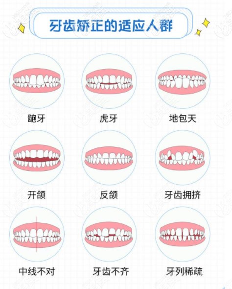 牙齒矯正適應(yīng)的人群 牙齒矯正適應(yīng)的人群