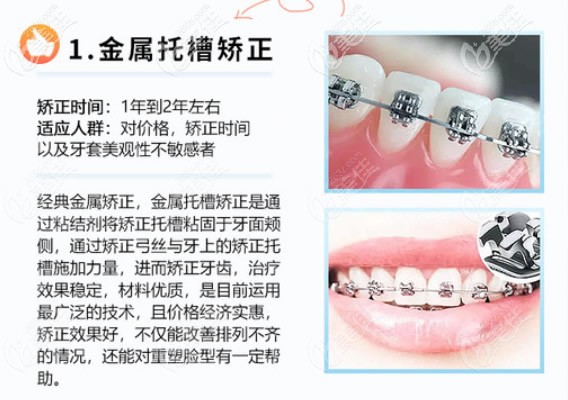 金屬托槽矯正價(jià)格實(shí)惠效果好 金屬托槽矯正價(jià)格實(shí)惠效果好