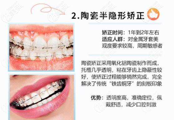 陶瓷半隱形矯正優(yōu)勢(shì) 陶瓷半隱形矯正優(yōu)勢(shì)