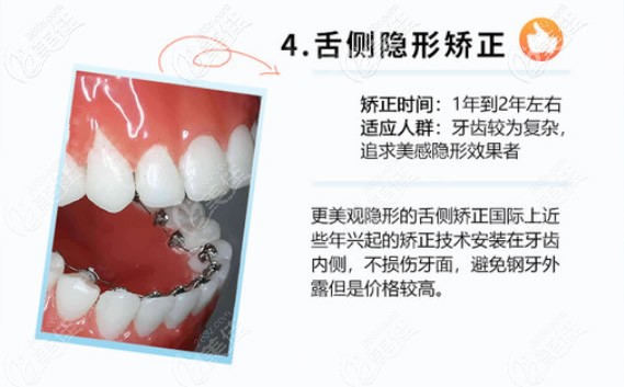 舌側(cè)隱形矯正價(jià)格較高 舌側(cè)隱形矯正價(jià)格較高