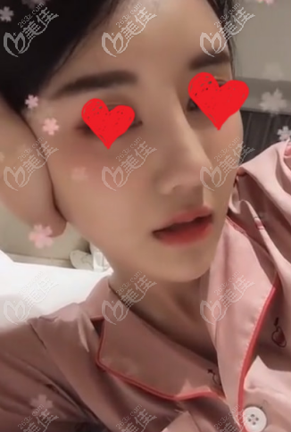 打破“千萬(wàn)別取鼻中隔做鼻尖是因?yàn)闀?huì)穿破鼻頭”的謠言