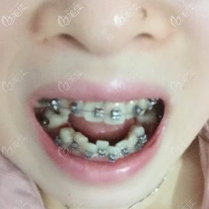 初戴牙套 初戴牙套