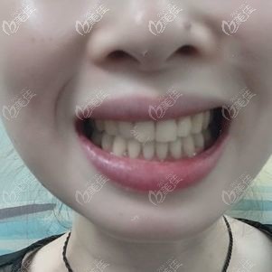 我才戴了三個(gè)月奧美科金屬托槽正畸,就發(fā)現(xiàn)原本參差不齊的牙齒變整齊了