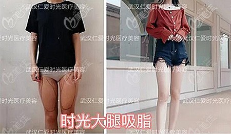 國慶雙節(jié)到武漢仁愛時光吸脂價格便宜嗎?據(jù)說大腿360度環(huán)吸抽脂才6999元起
