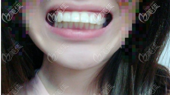 門牙前凸的圖片 門牙前凸的圖片