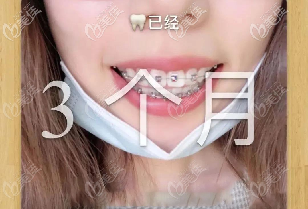 3個月后的牙齒變化情況 3個月后的牙齒變化情況