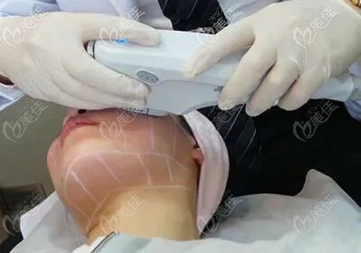 fotona4d眼周除皺治療 fotona4d眼周除皺治療