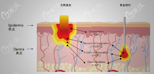 黃金微針和點(diǎn)陣激光的治療區(qū)別