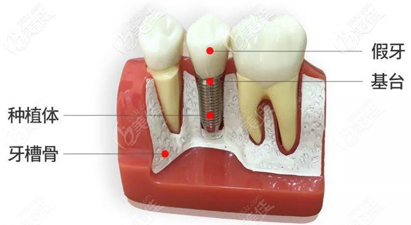骨質(zhì)疏松癥并不是種植牙的相對禁忌癥