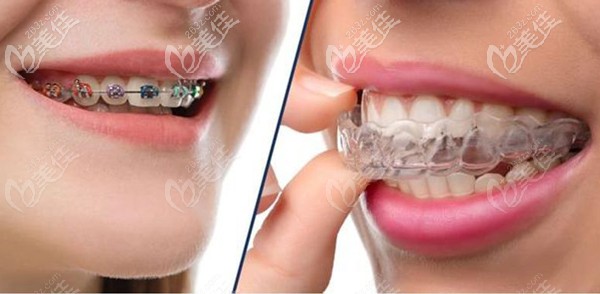 長沙做牙齒矯正的收費(fèi)標(biāo)準(zhǔn) 長沙做牙齒矯正的收費(fèi)標(biāo)準(zhǔn)