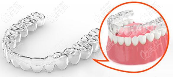 隱形牙齒矯正示意圖