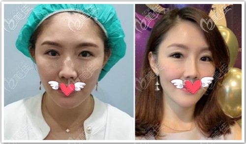 少女線提升前后對(duì)比效果照片 少女線提升前后對(duì)比效果照片