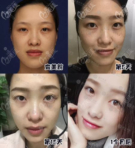 重慶華美祛斑案例