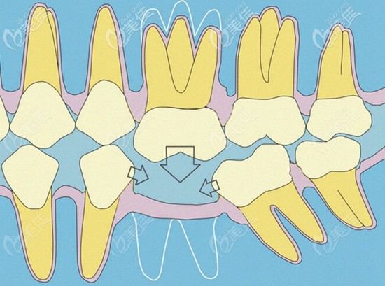 牙齒缺失后應(yīng)盡早治療 牙齒缺失后應(yīng)盡早治療