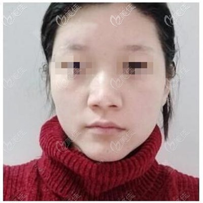 假體隆鼻手術(shù)前 假體隆鼻手術(shù)前